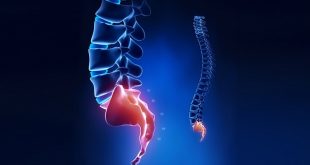 Болит крестец, что делать?